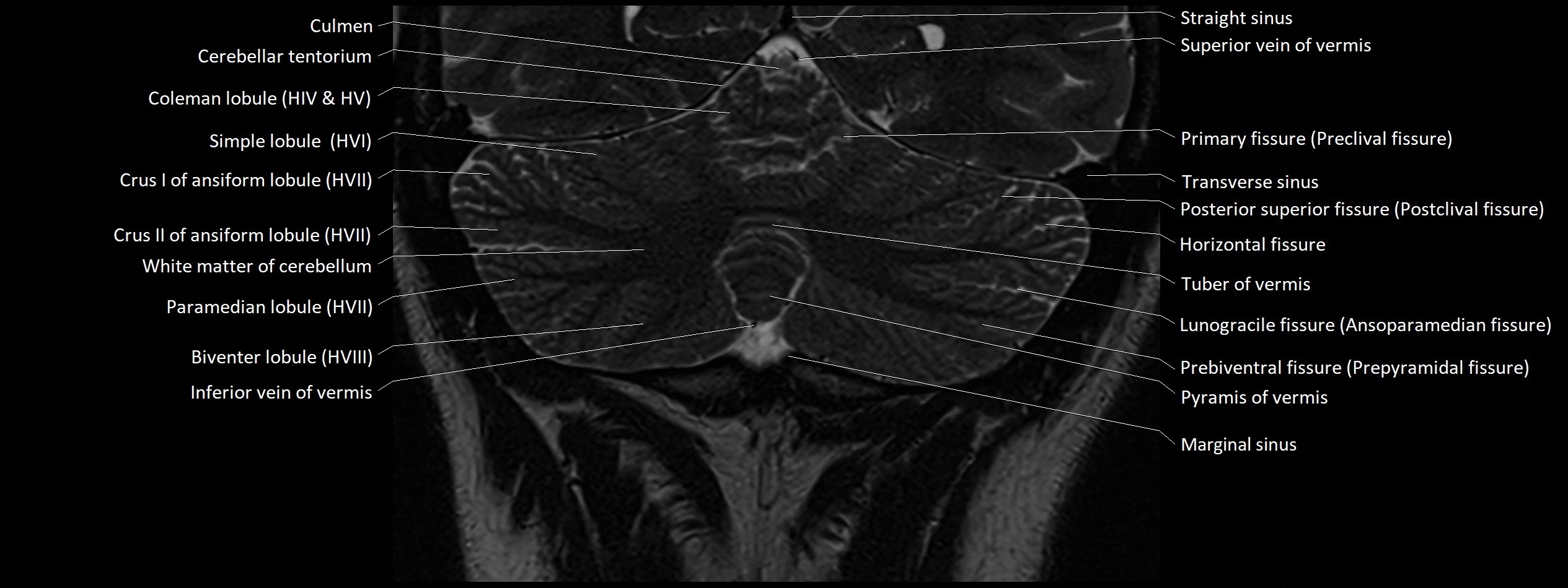 Anatomy of cerebellum coronal cross sectional 3T image 19.webp